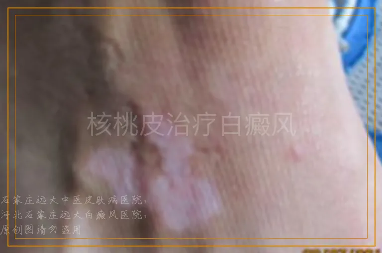 核桃皮治疗白癜风