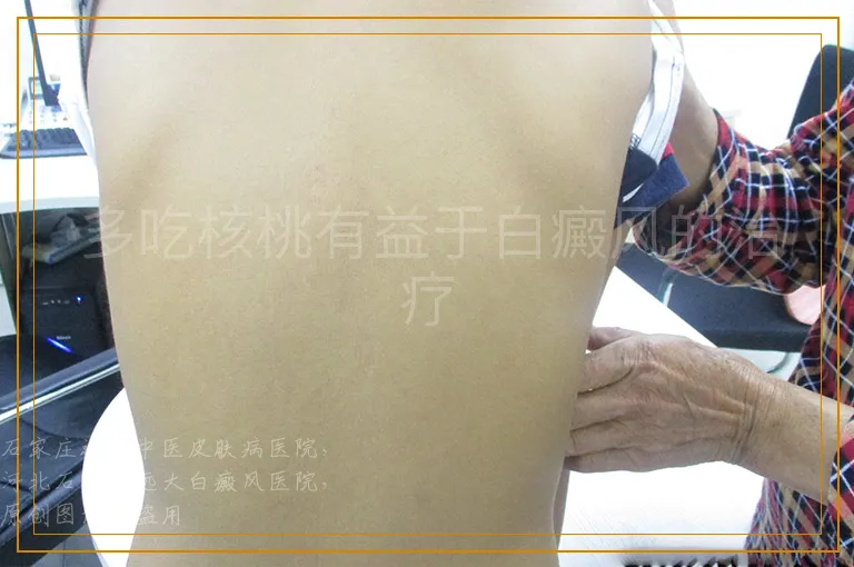 多吃核桃有益于白癜风的治疗