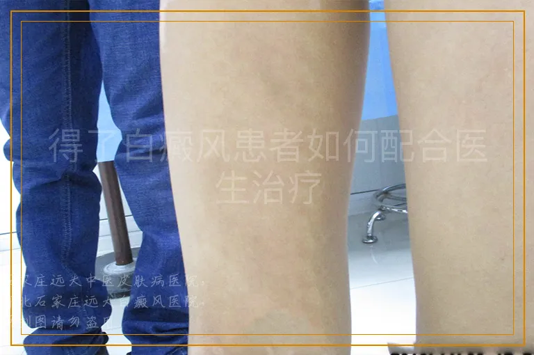得了白癜风患者如何配合医生治疗