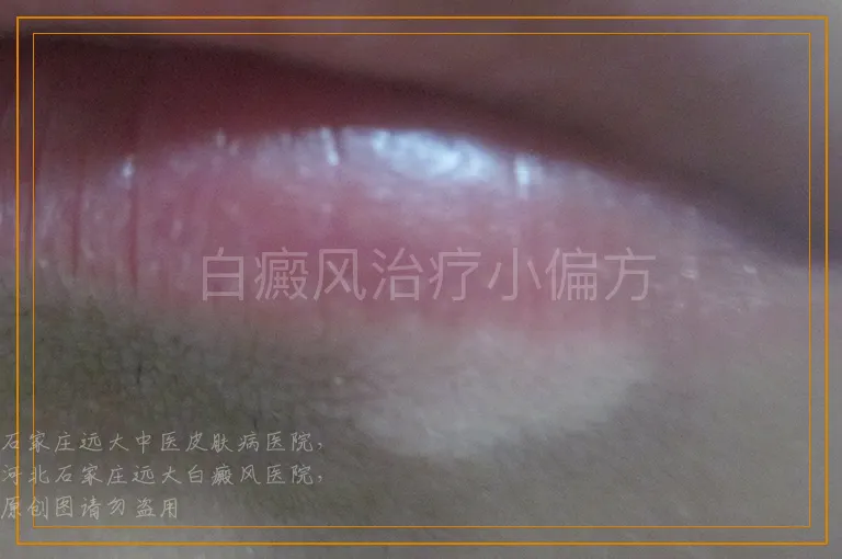 白癜风治疗小偏方