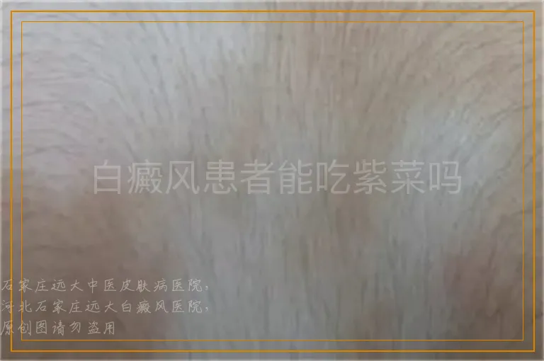 白癜风患者能吃紫菜吗