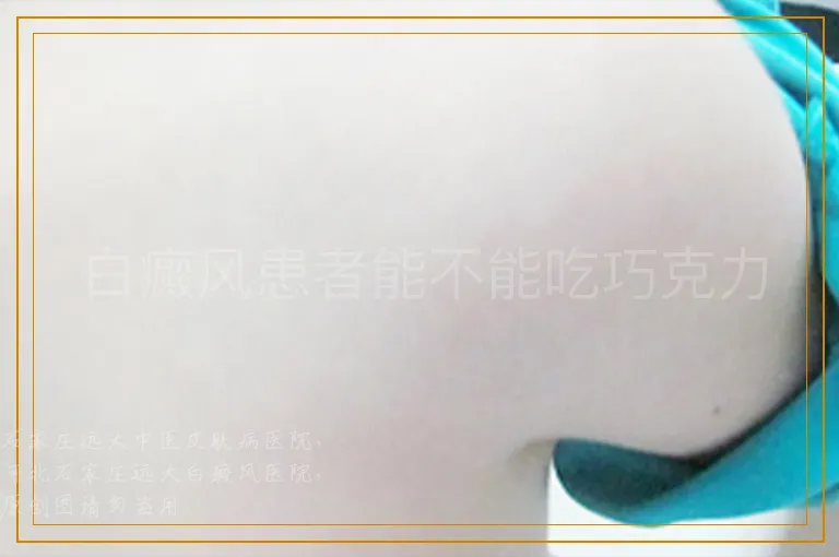 白癜风患者能不能吃巧克力