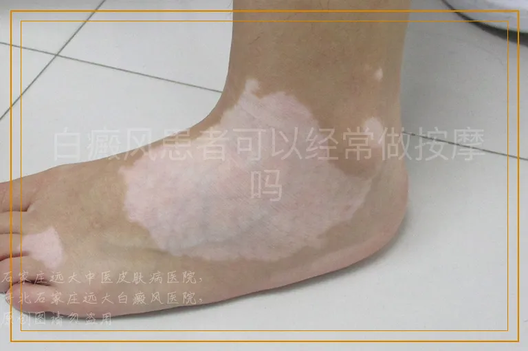 白癜风患者可以经常做按摩吗