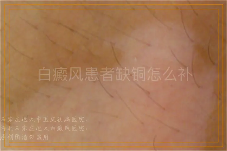 白癜风患者缺铜怎么补