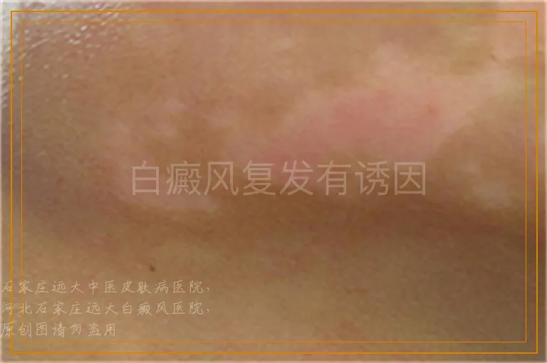 白癜风复发有诱因