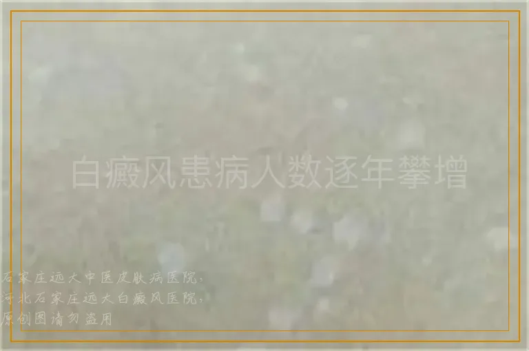 白癜风患病人数逐年攀增