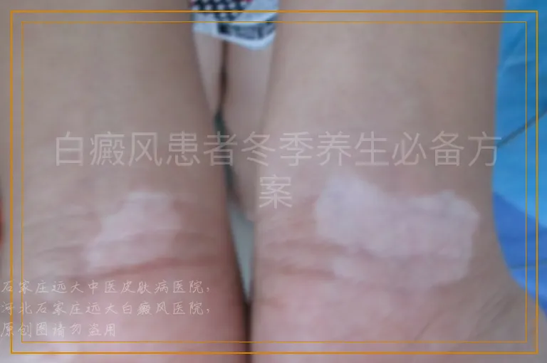 白癜风患者冬季养生必备方案