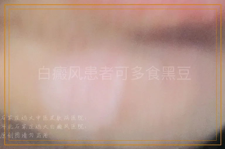 白癜风患者可多食黑豆