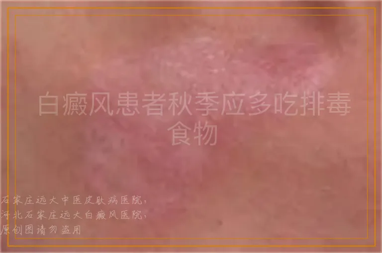 白癜风患者秋季应多吃排毒食物