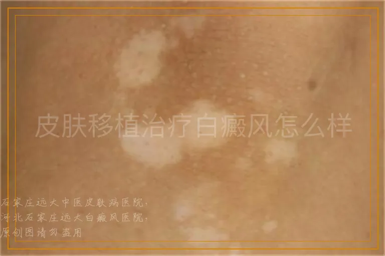 皮肤移植治疗白癜风怎么样