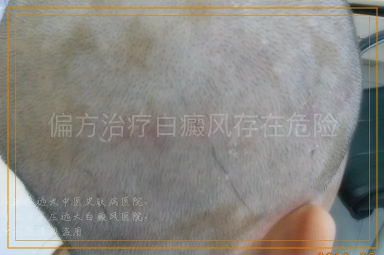 偏方治疗白癜风存在危险