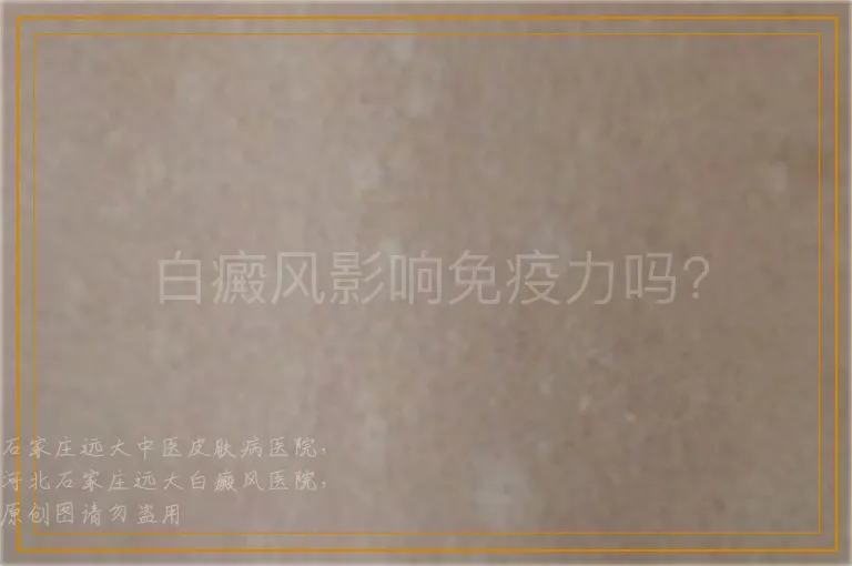 白癜风影响免疫力吗?