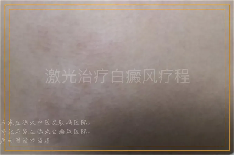 激光治疗白癜风疗程