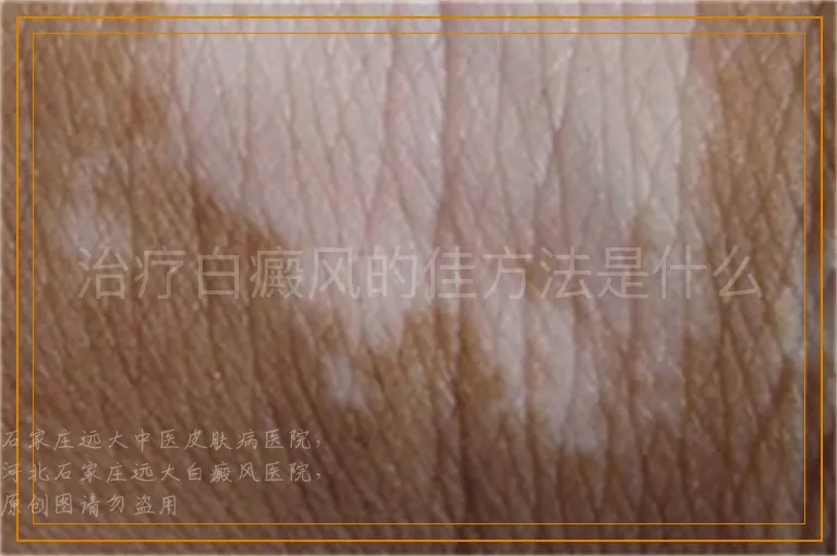 治疗白癜风的佳方法是什么