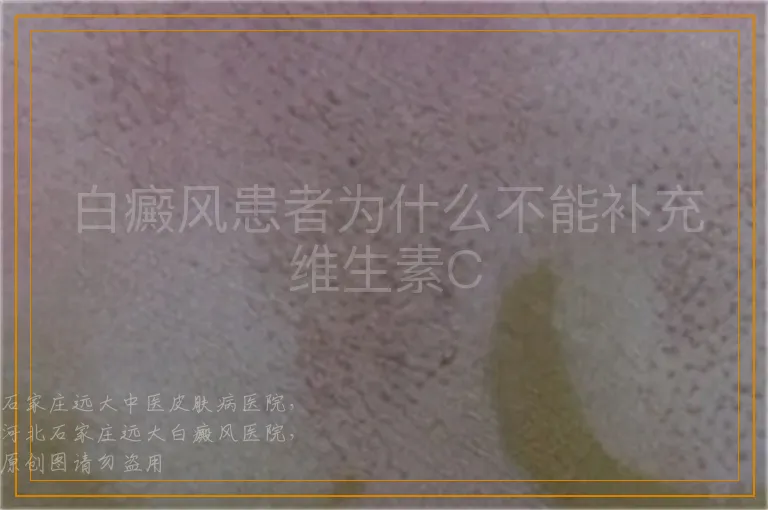 白癜风患者为什么不能补充维生素C