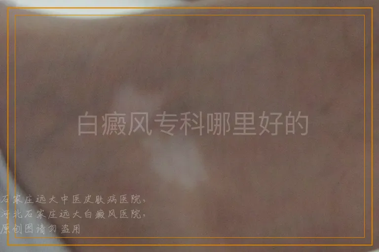 白癜风专科哪里好的