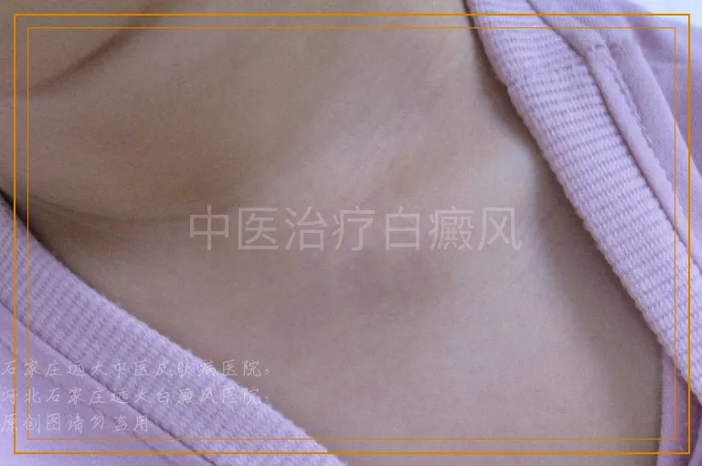 中医治疗白癜风