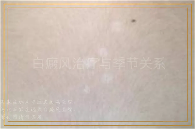 白癜风治疗与季节关系