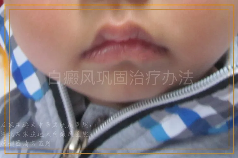 白癜风巩固治疗办法