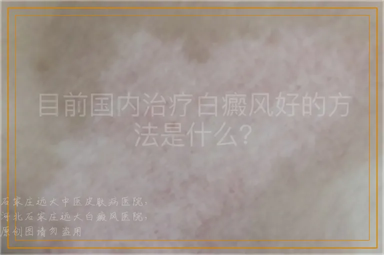 目前国内治疗白癜风好的方法是什么？