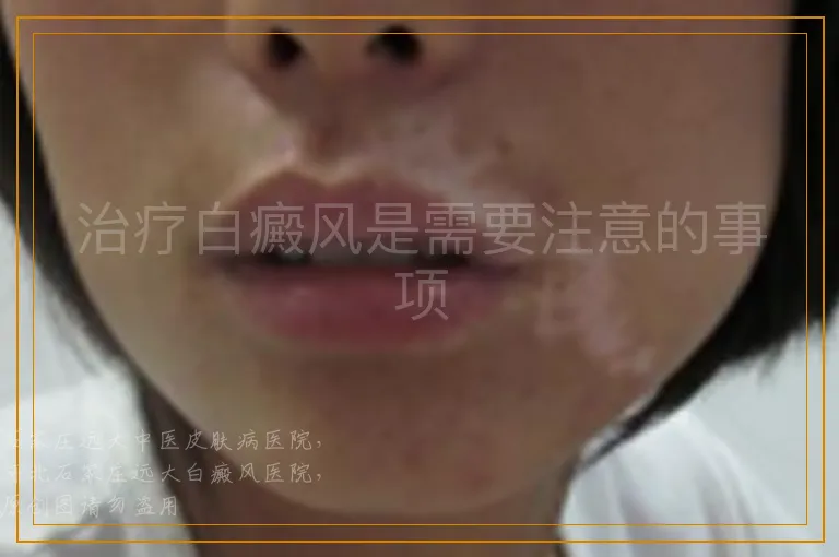 治疗白癜风是需要注意的事项