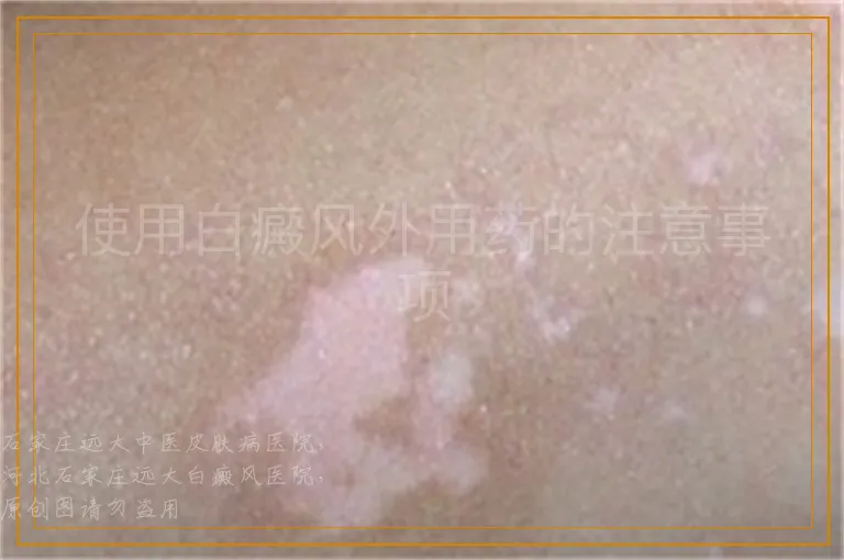 使用白癜风外用药的注意事项