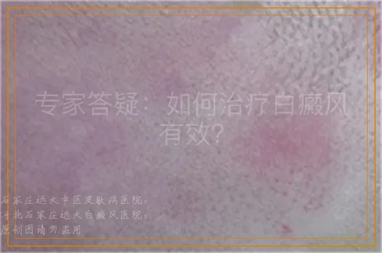 专家答疑：如何治疗白癜风有效？