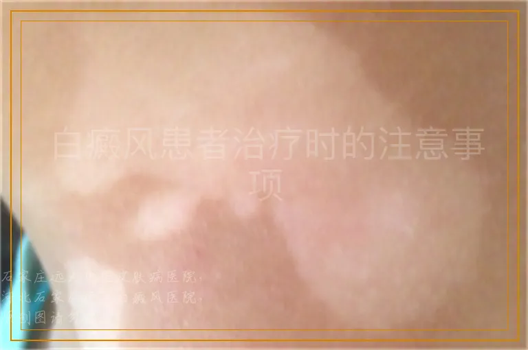 白癜风患者治疗时的注意事项