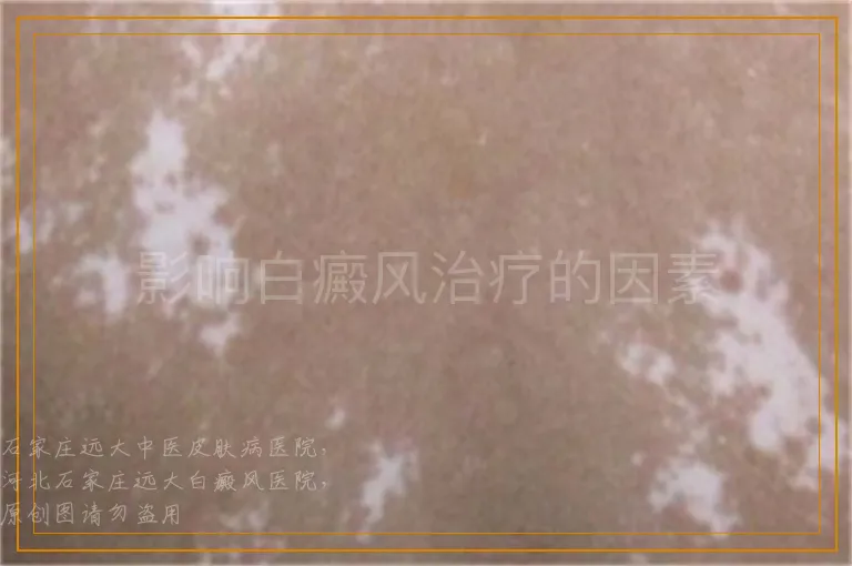 影响白癜风治疗的因素