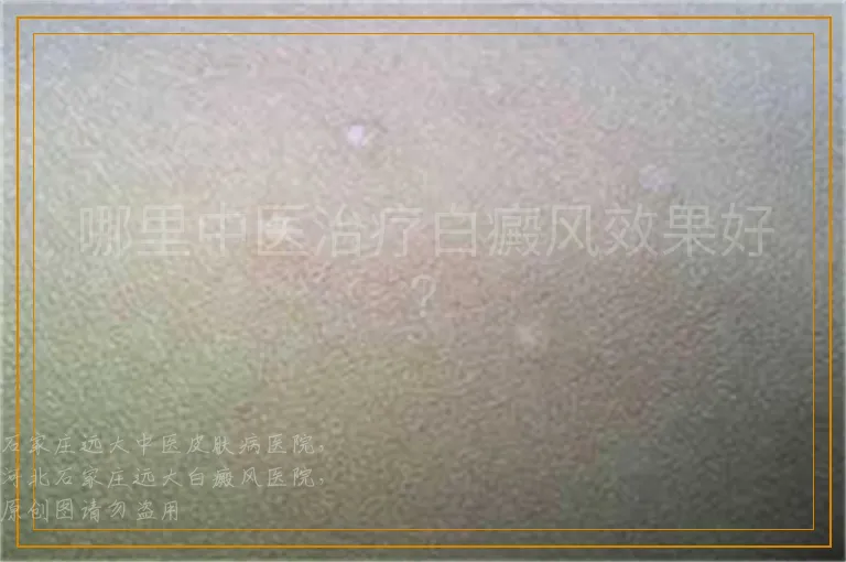 哪里中医治疗白癜风效果好？