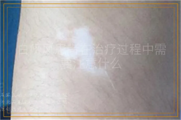 白癜风患者在治疗过程中需要注意什么