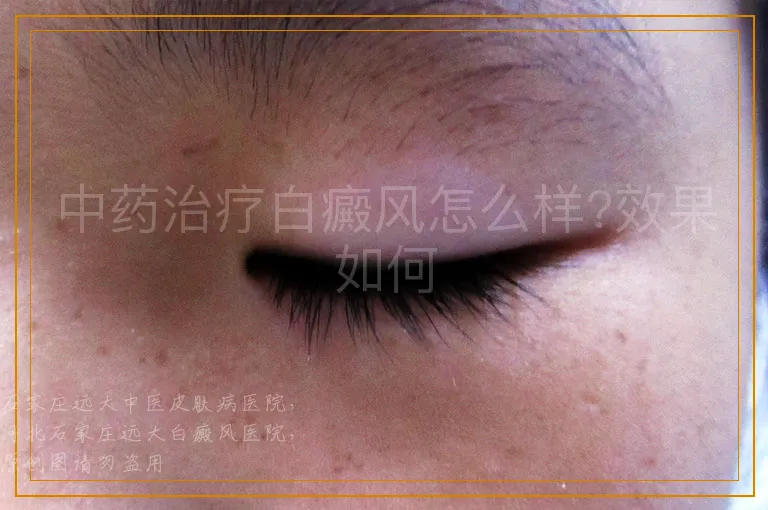 中药治疗白癜风怎么样?效果如何