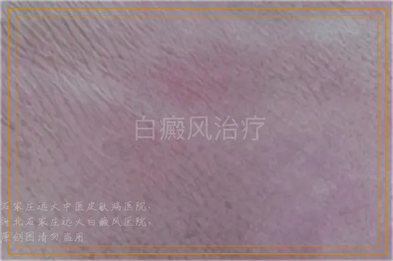 白癜风治疗