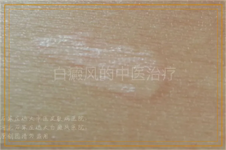 白癜风的中医治疗