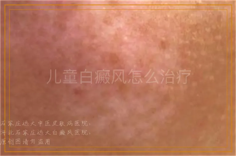 儿童白癜风怎么治疗
