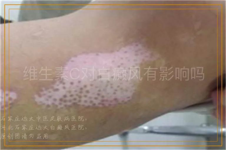 维生素C对白癜风有影响吗