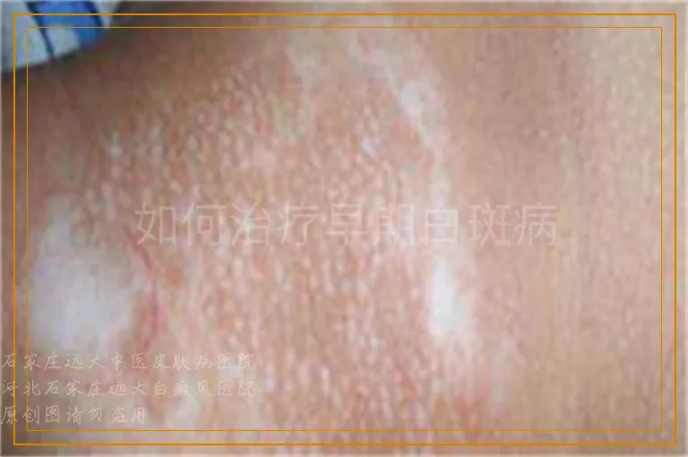 如何治疗早期白斑病