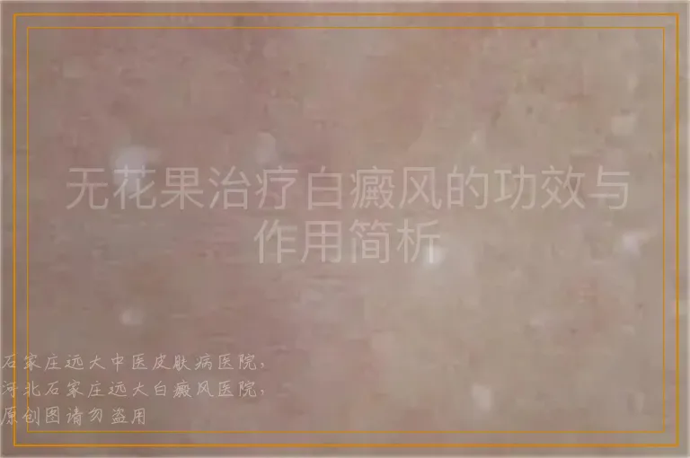 无花果治疗白癜风的功效与作用简析