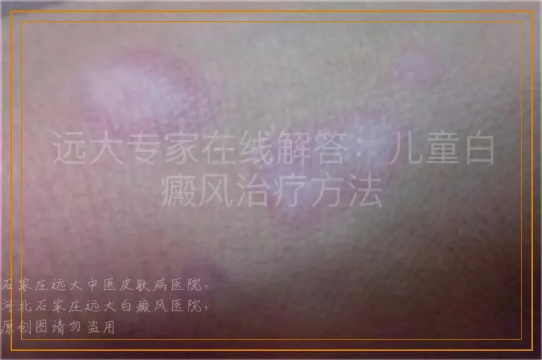 远大专家在线解答：儿童白癜风治疗方法