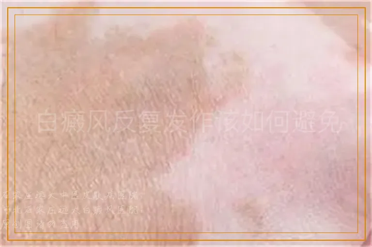 白癜风反复发作该如何避免
