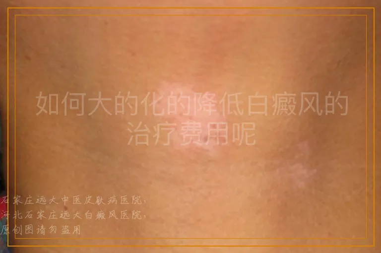 如何大的化的降低白癜风的治疗费用呢