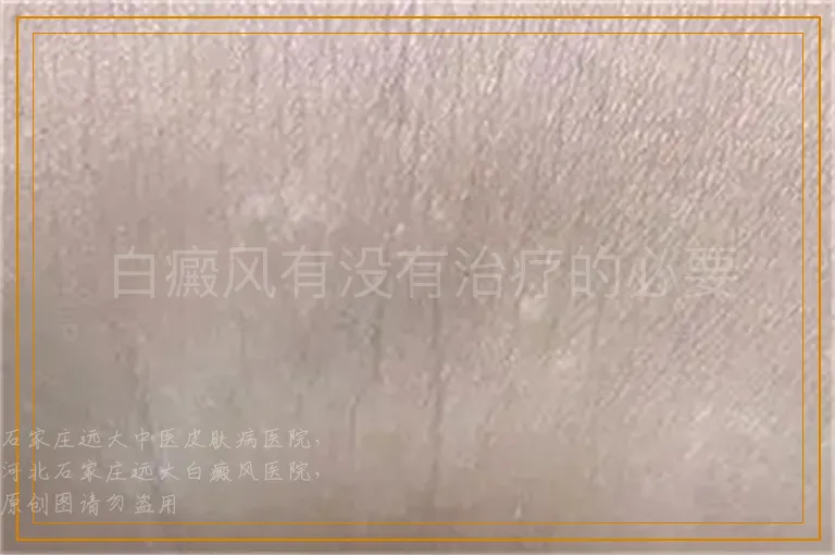白癜风有没有治疗的必要