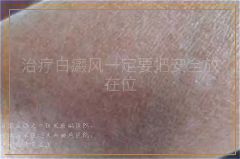 治疗白癜风一定要把安全放在位