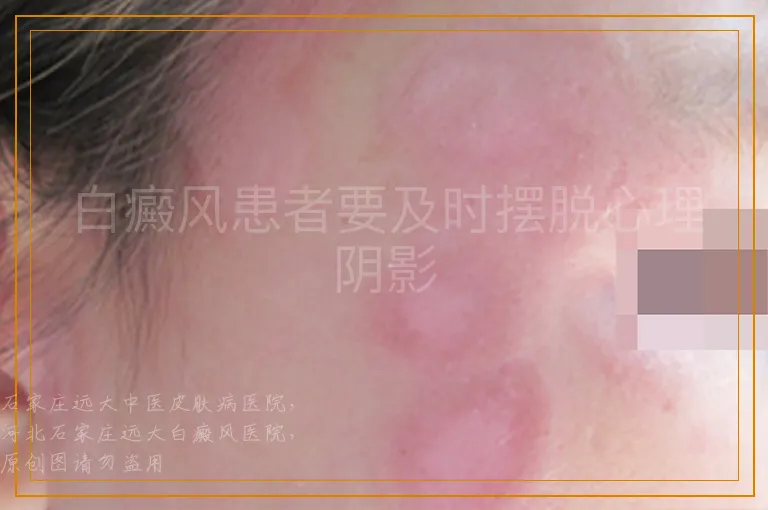白癜风患者要及时摆脱心理阴影