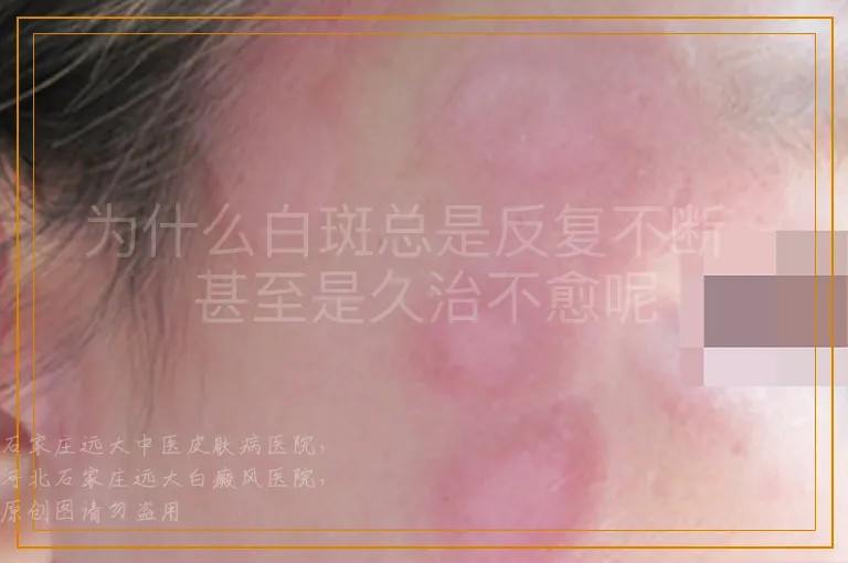 为什么白斑总是反复不断  甚至是久治不愈呢