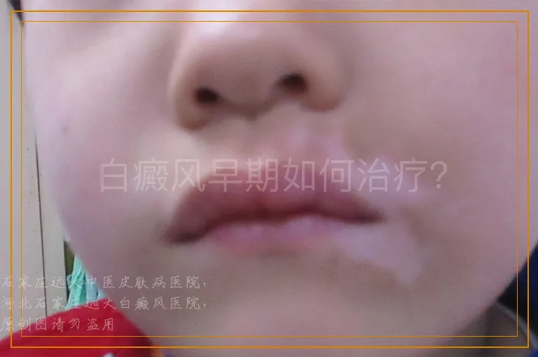 白癜风早期如何治疗？