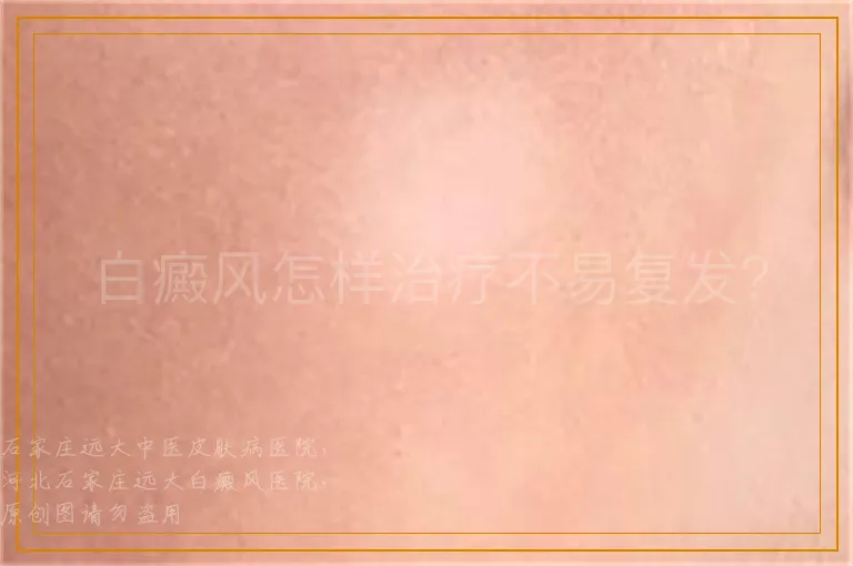 白癜风怎样治疗不易复发？