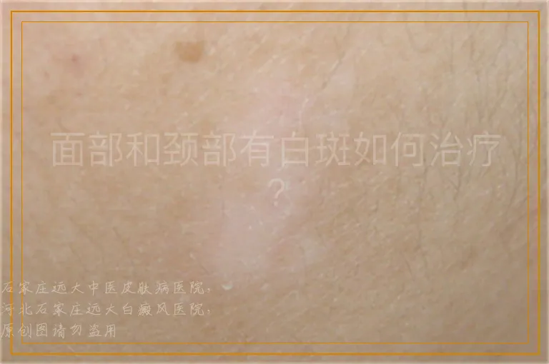 面部和颈部有白斑如何治疗?