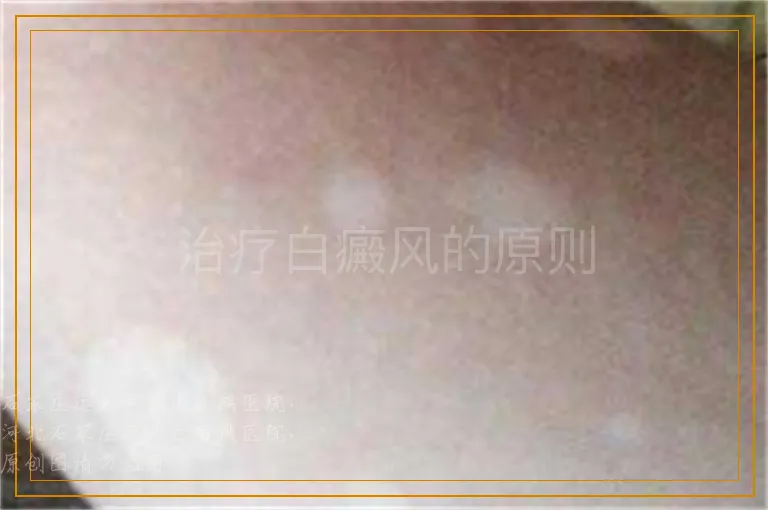 治疗白癜风的原则
