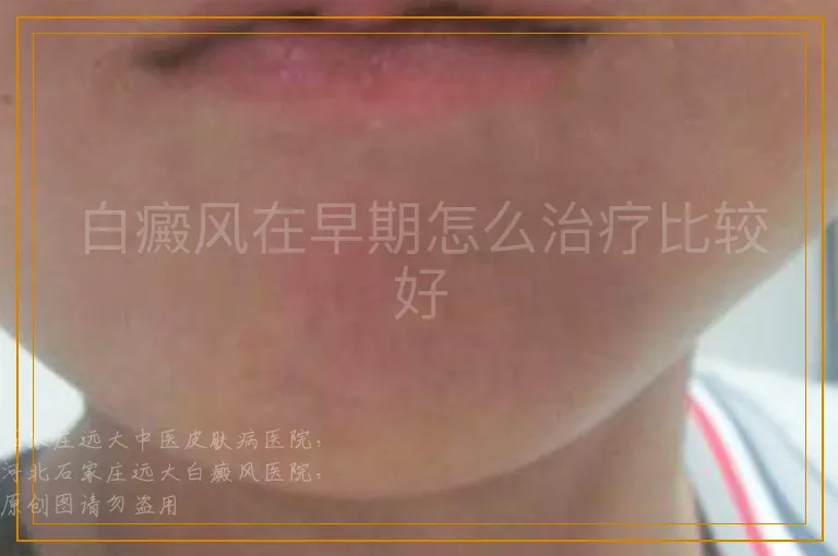 白癜风在早期怎么治疗比较好